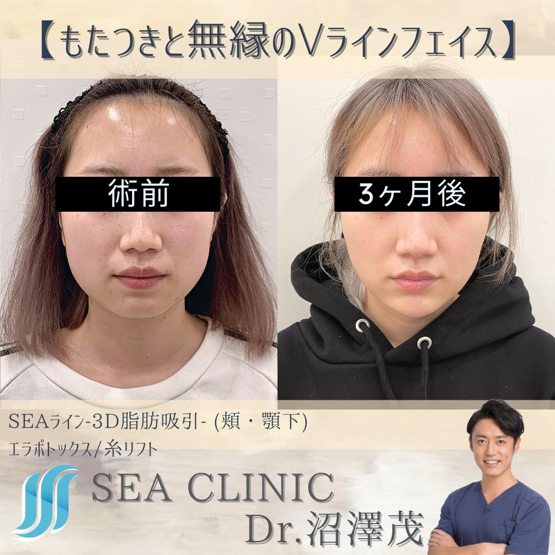もたつきと無縁のVラインフェイス - SEA CLINIC −シークリニック 銀座