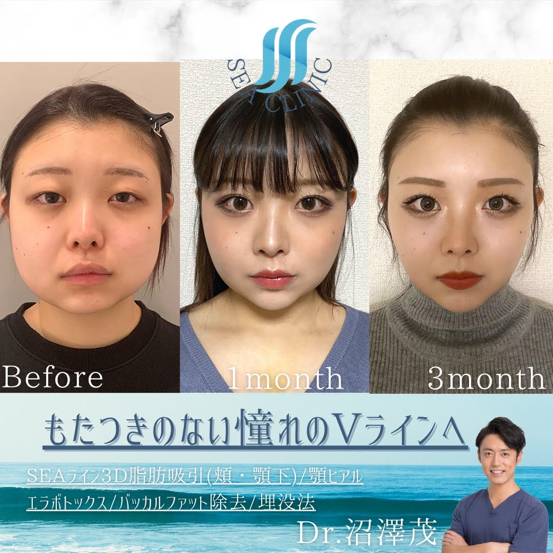 HEADRANG 小顔Vライン顔左右非対称矯正 筋膜小顔矯正で、口元