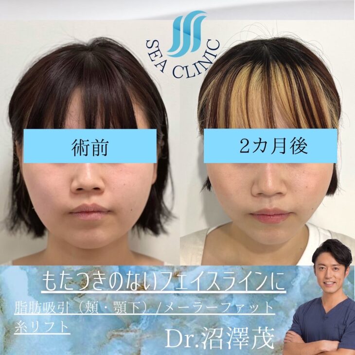 もたつきのないフェイスラインへ Sea Clinic −シークリニック 銀座― 理想を叶える小顔治療