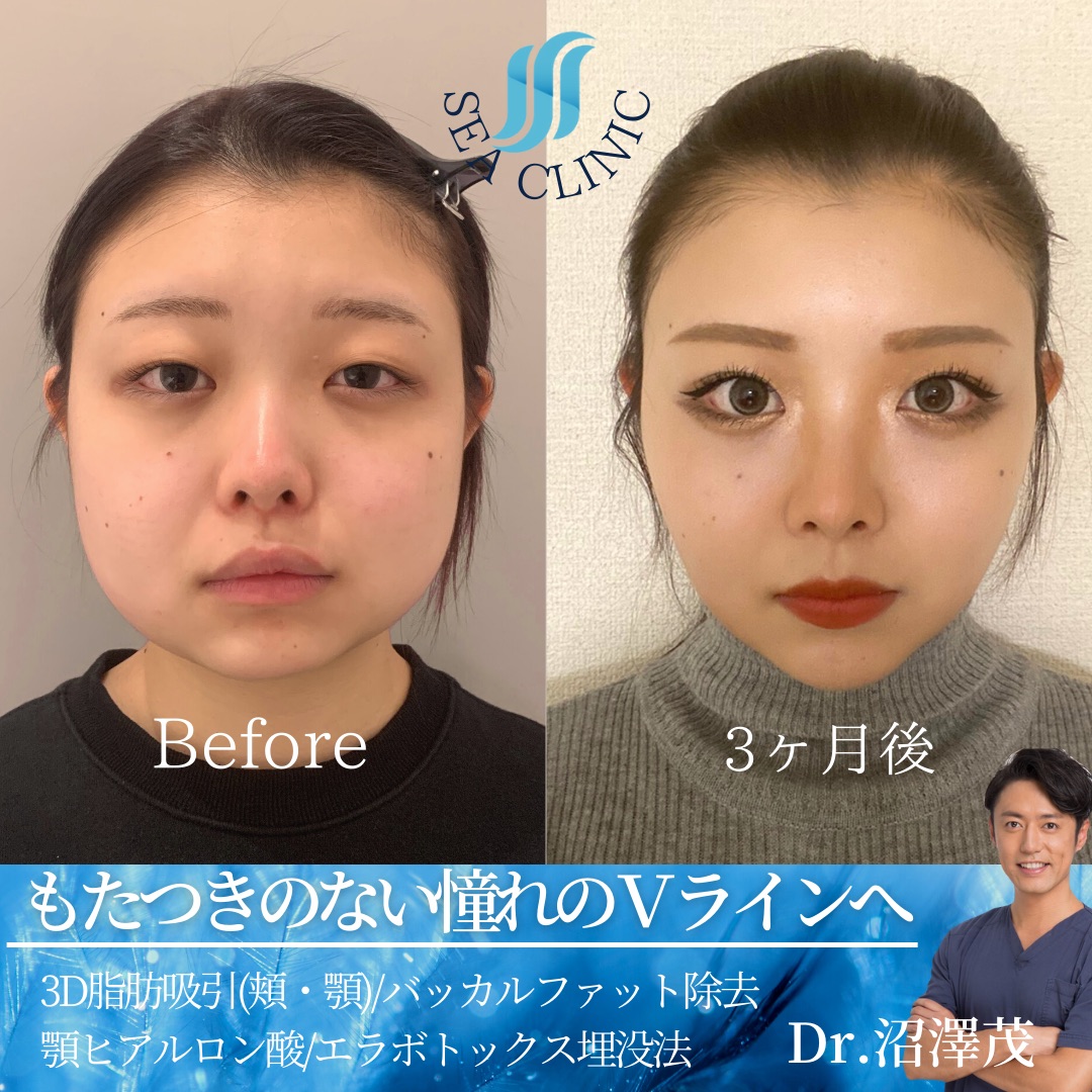 中古】 メスを使わないセンスアップ美容整形 直後から化粧の