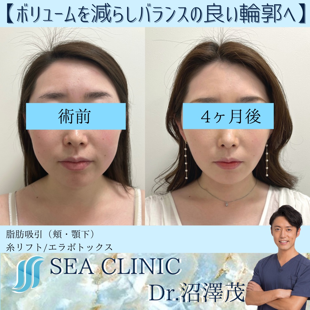 バランスの良い輪郭で小顔美人へ Sea Clinic シークリニック 銀座 理想を叶える小顔治療