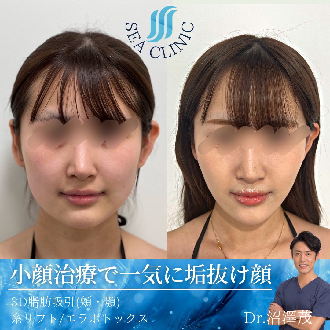 垢抜けなら輪郭！脂肪吸引でここまで変わる。 - SEA CLINIC −シークリニック 銀座― 理想を叶える小顔治療