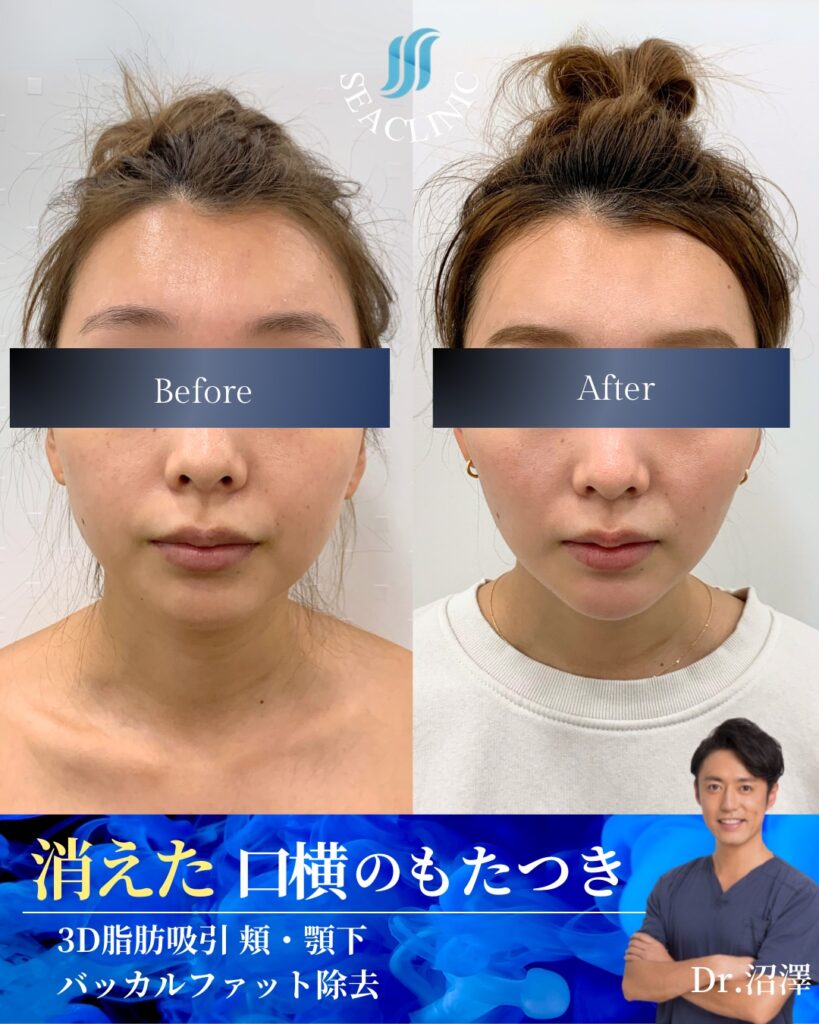 消えた口横のもたつき
