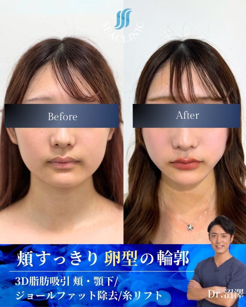 頬スッキリ卵型の輪郭。