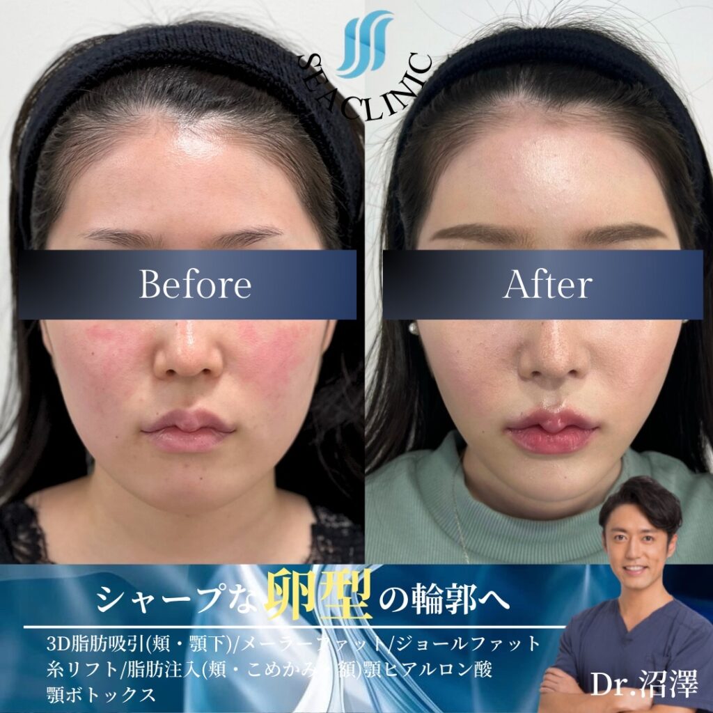 シャープな卵型の輪郭へ