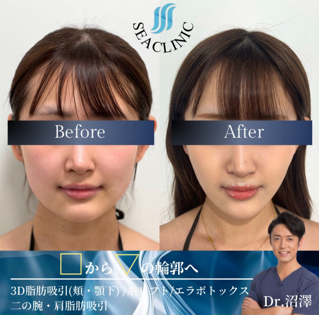 脂肪吸引だけで綺麗なVラインに
