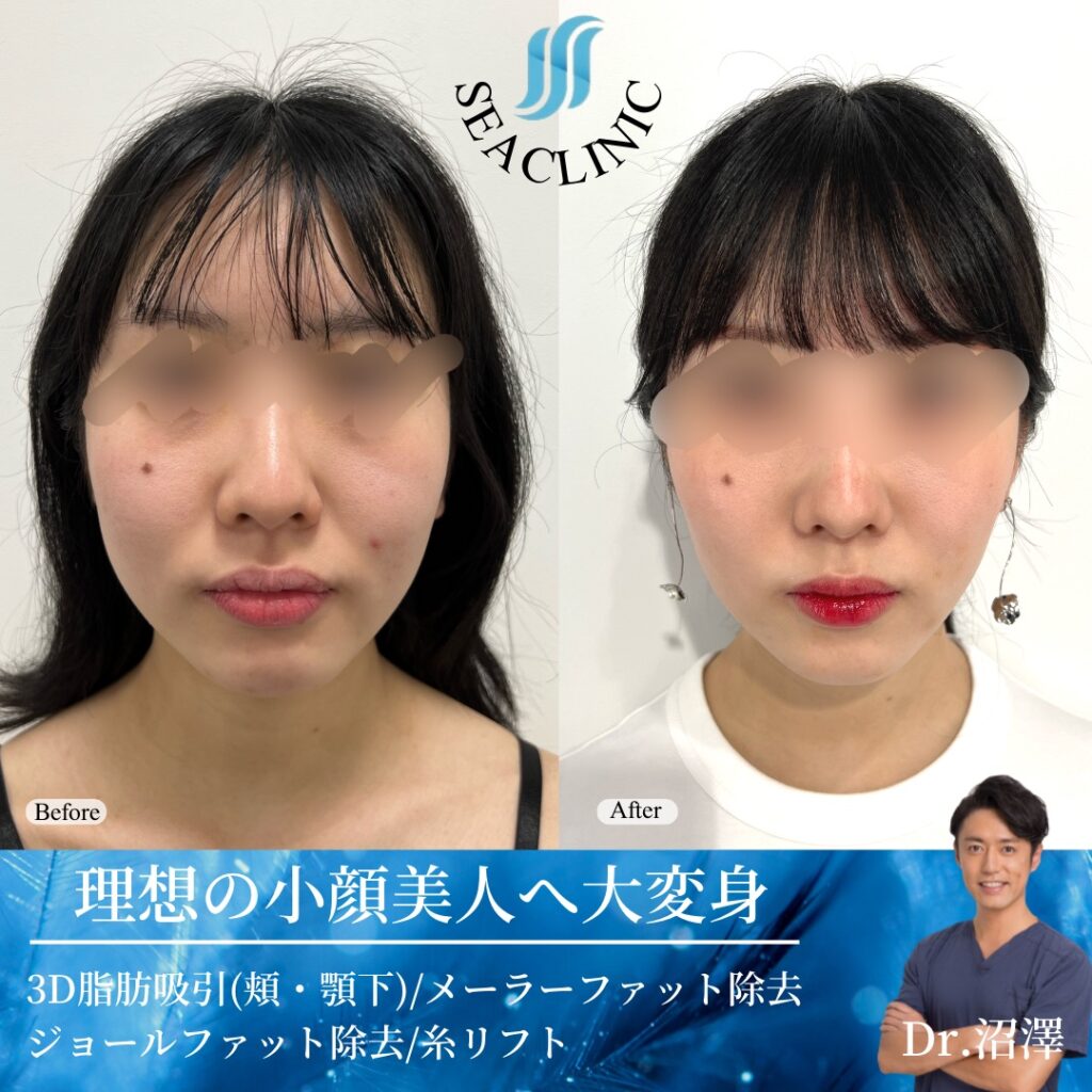 理想の小顔美人へ大変身