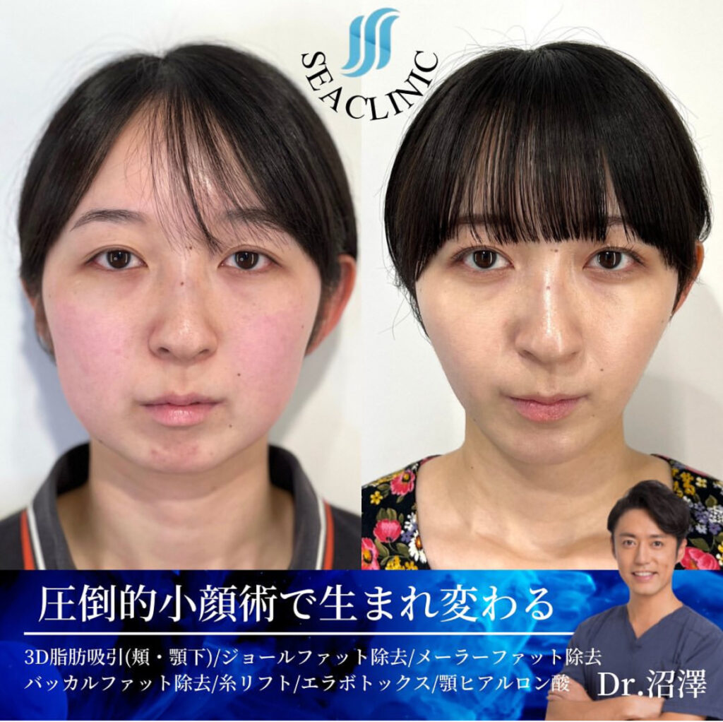圧倒的小顔術で生まれ変わる