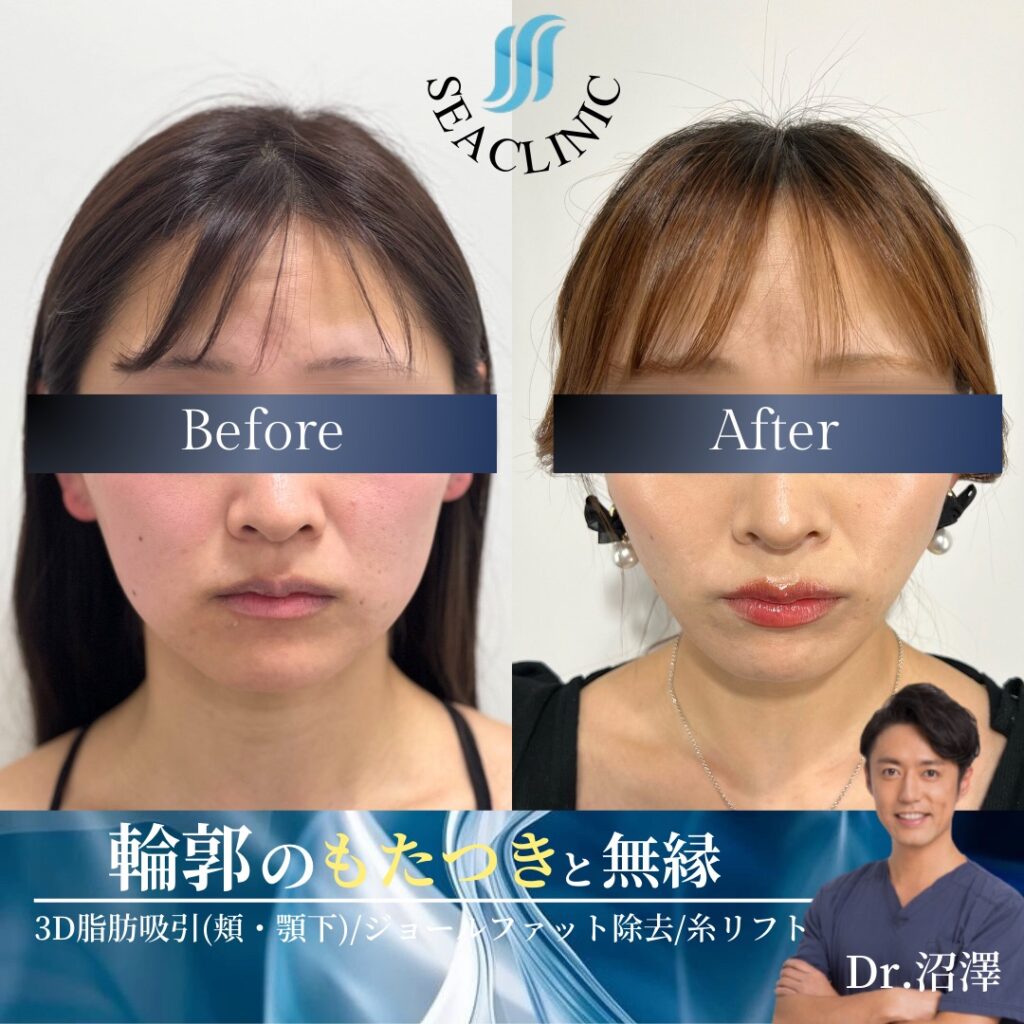 骨切りなしで、ここまでの変化。