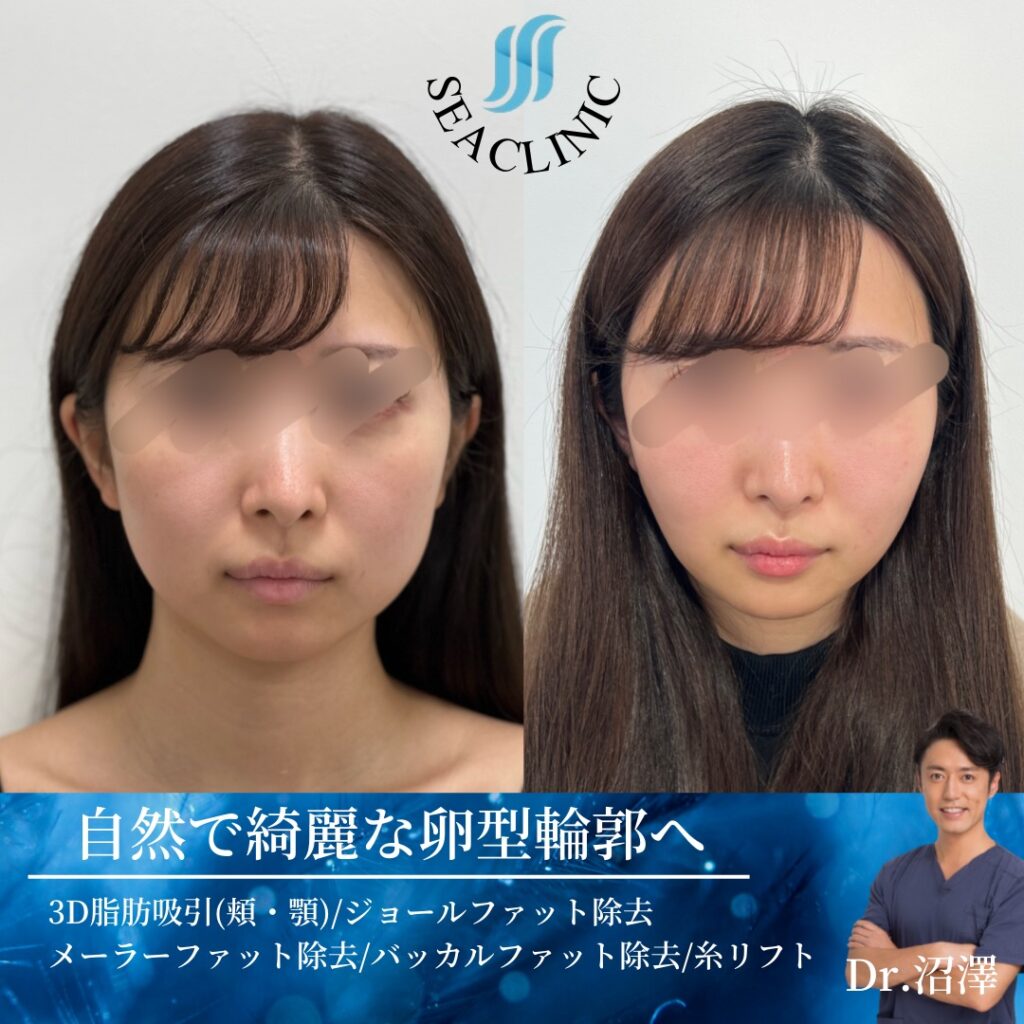 自然で綺麗な卵型輪郭へ