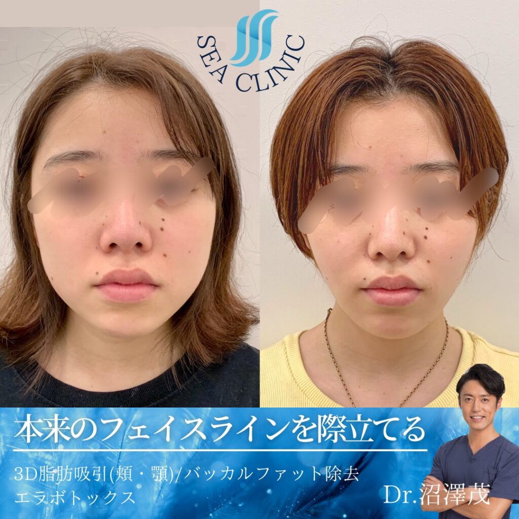 本来のフェイスラインを際立てる。
