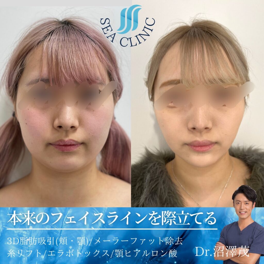 本来のフェイスラインを際立てる