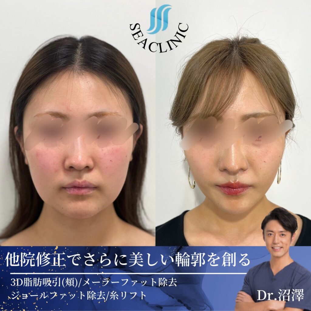 他院修正でさらに美しい輪郭を創る