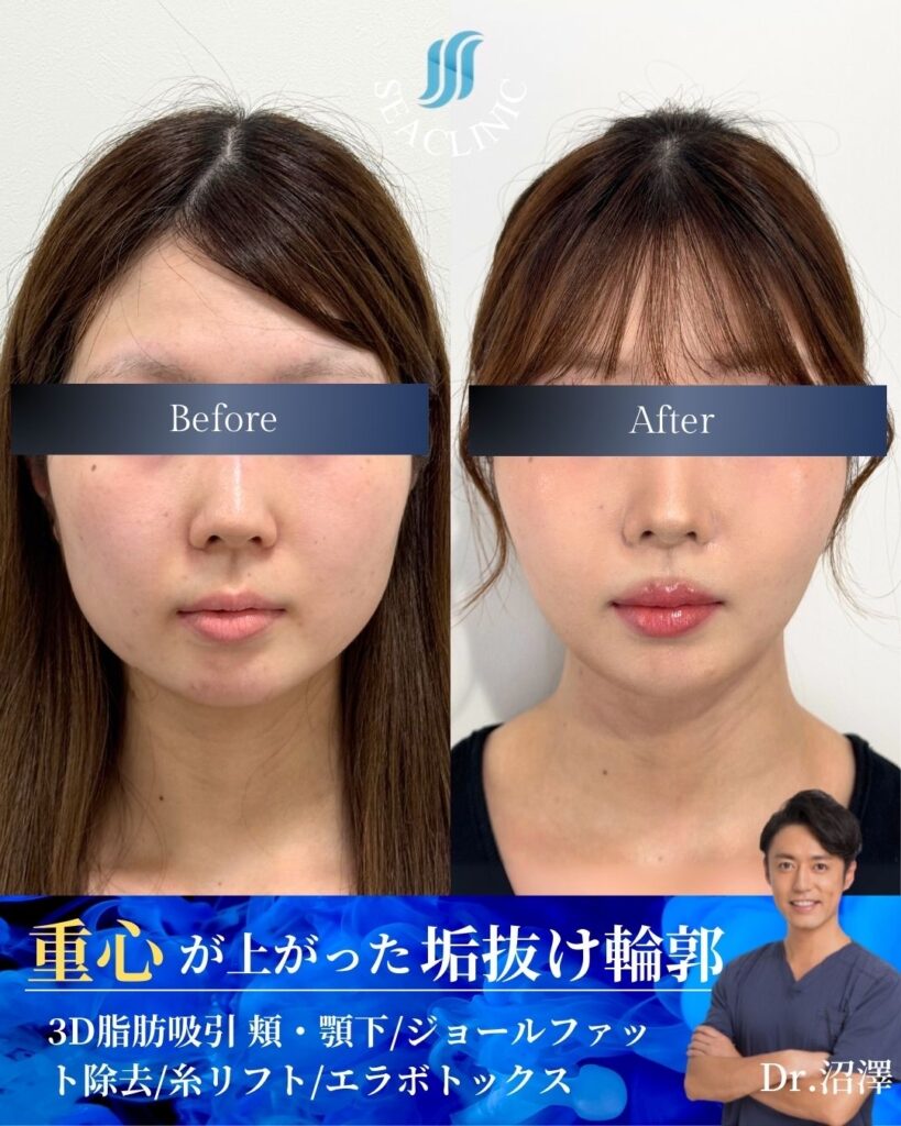 重心が上がった垢抜け輪郭