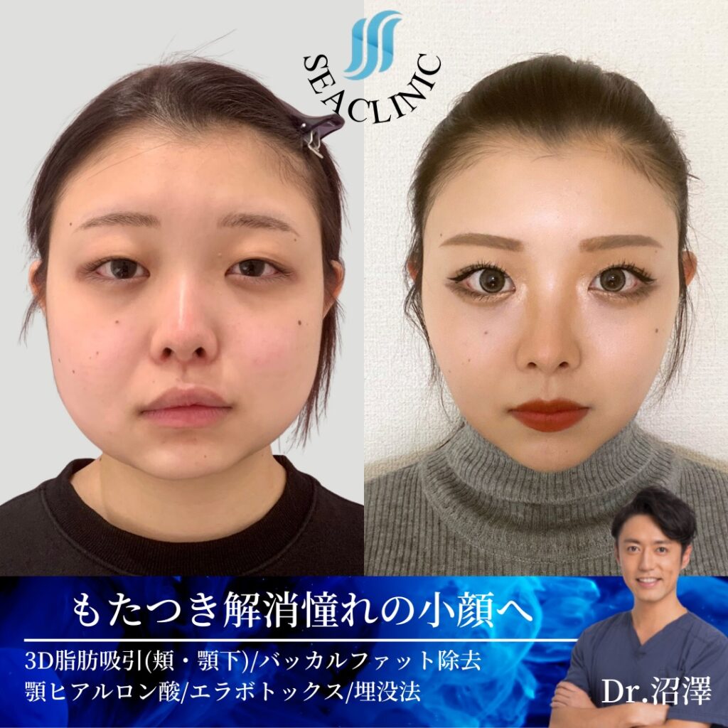 劇的変化！憧れの小顔へ