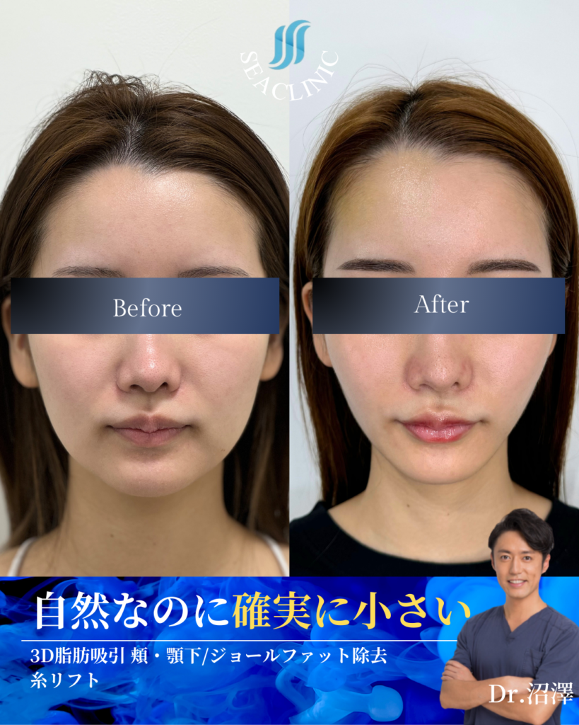 自然なのに確実に小さい　脂肪吸引