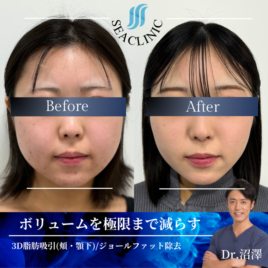 脂肪吸引に向いていない人の特徴